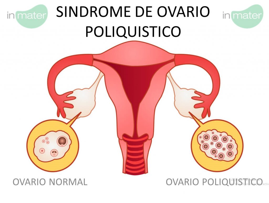 SÍNDROME DE OVARIOS POLIQUÍSTICOS - Noticias inmater